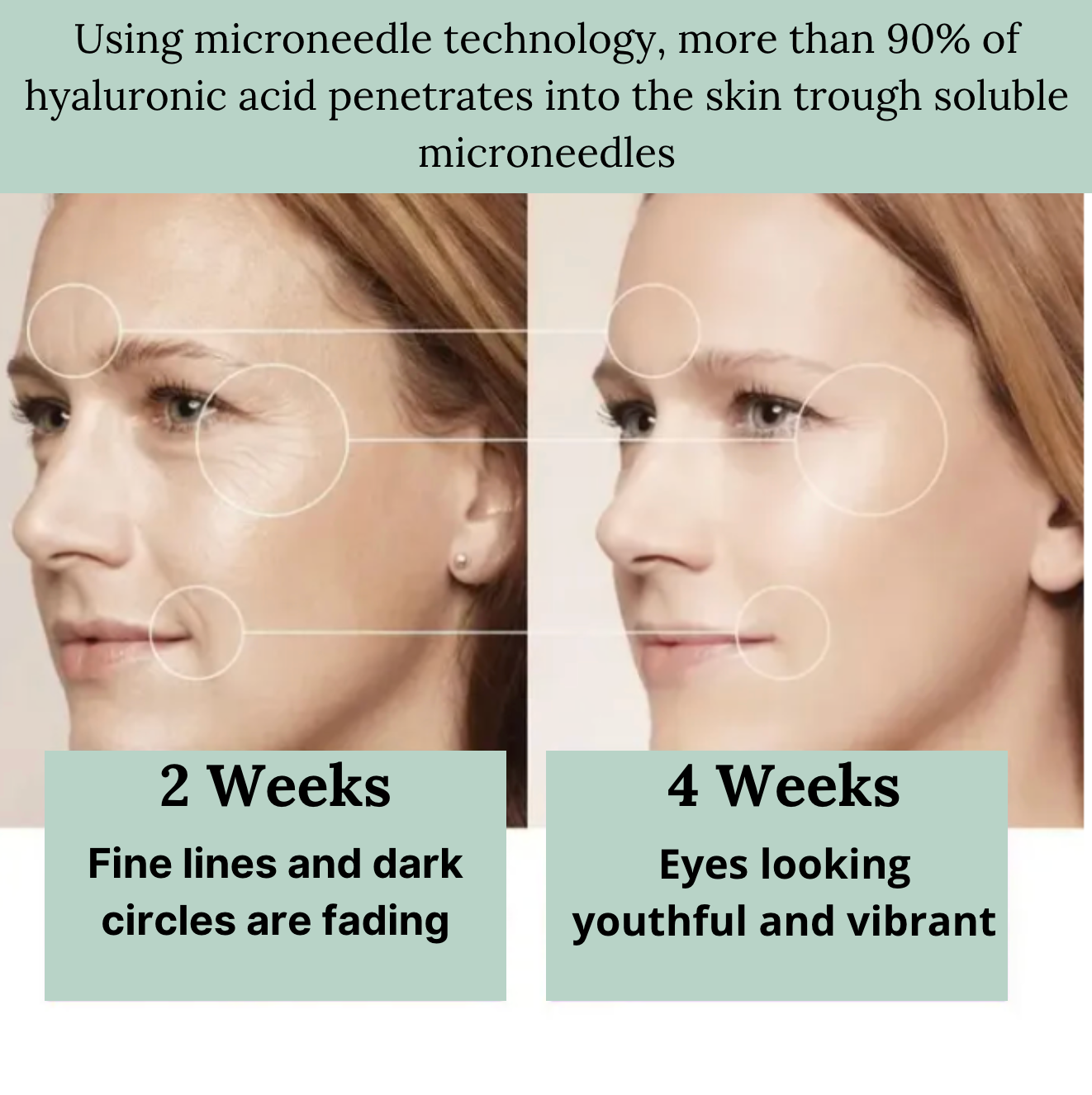 Microneedle EyePatches